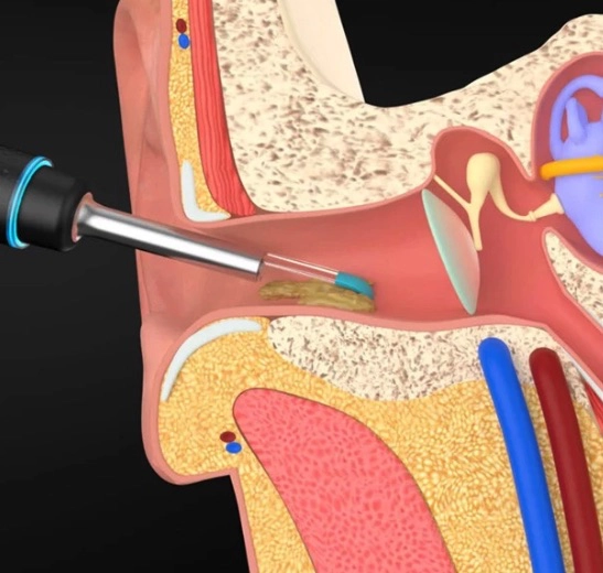 Bebird M9 Pro Ohr saubern